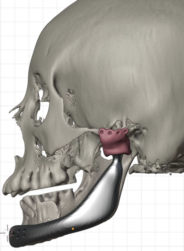 Vista lateral del diseño tridimensional de prótesis mandibular personalizada