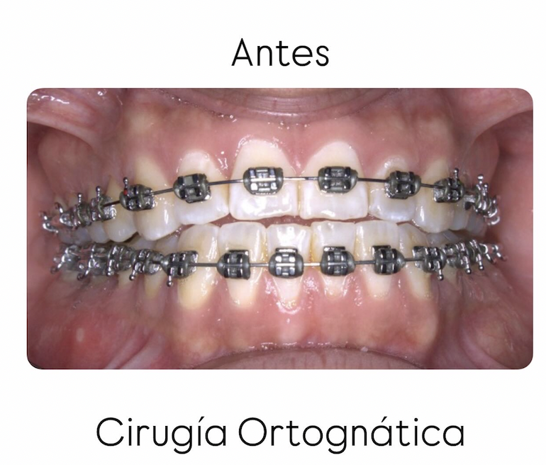 Oclusión frontal antes del tratamiento