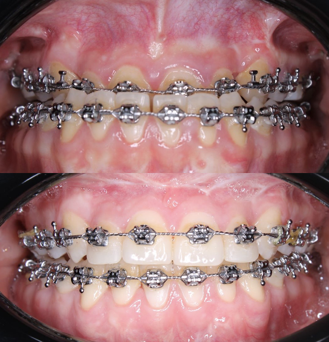 Comparación de oclusión dental antes y después del tratamiento